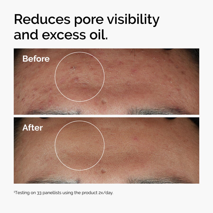 niacinamide-10-zinc-1-d6 ord-niacinamide-zinc-blemish-serum-before-after-pores.jpg