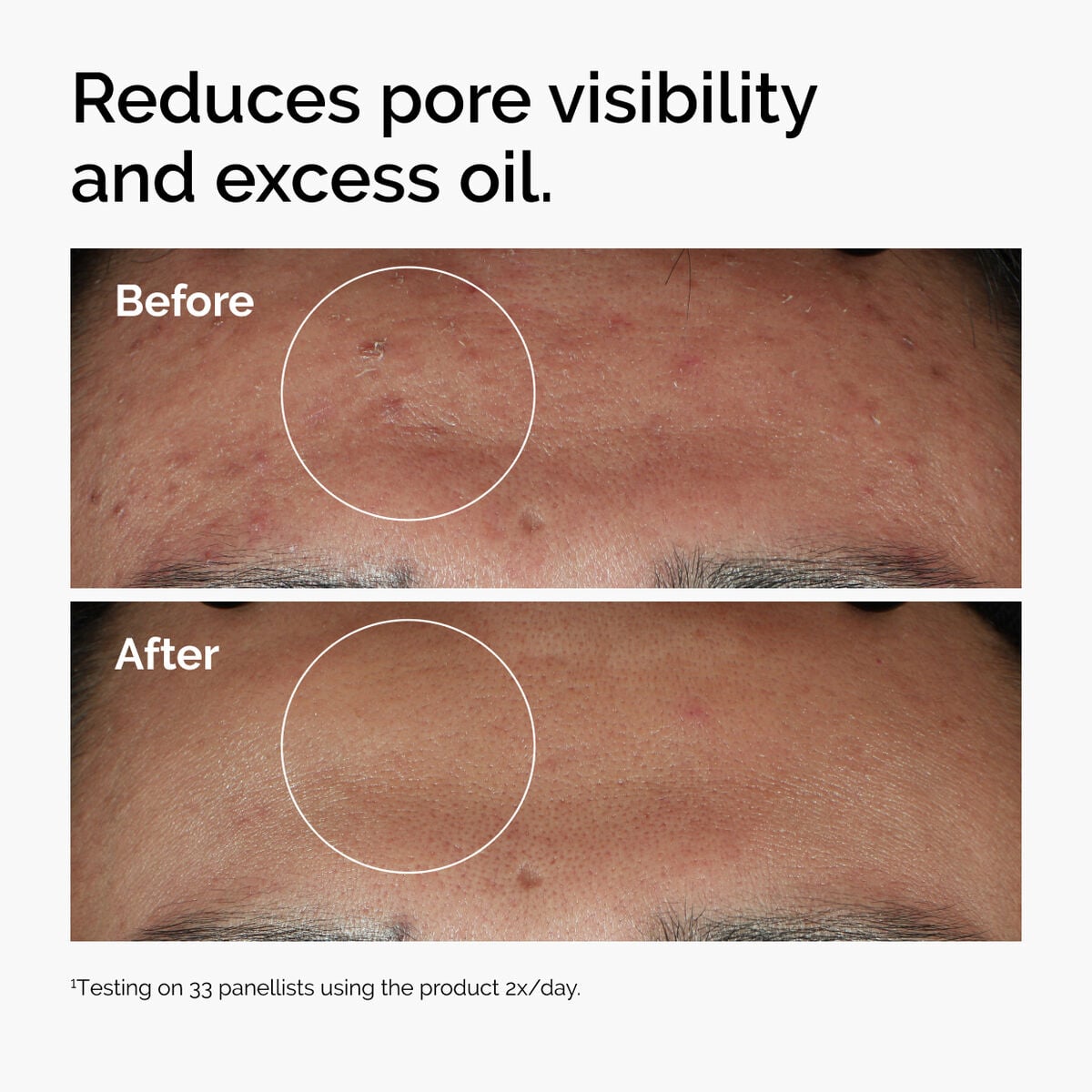 niacinamide-10-zinc-1-d6 ord-niacinamide-zinc-blemish-serum-before-after-pores.jpg