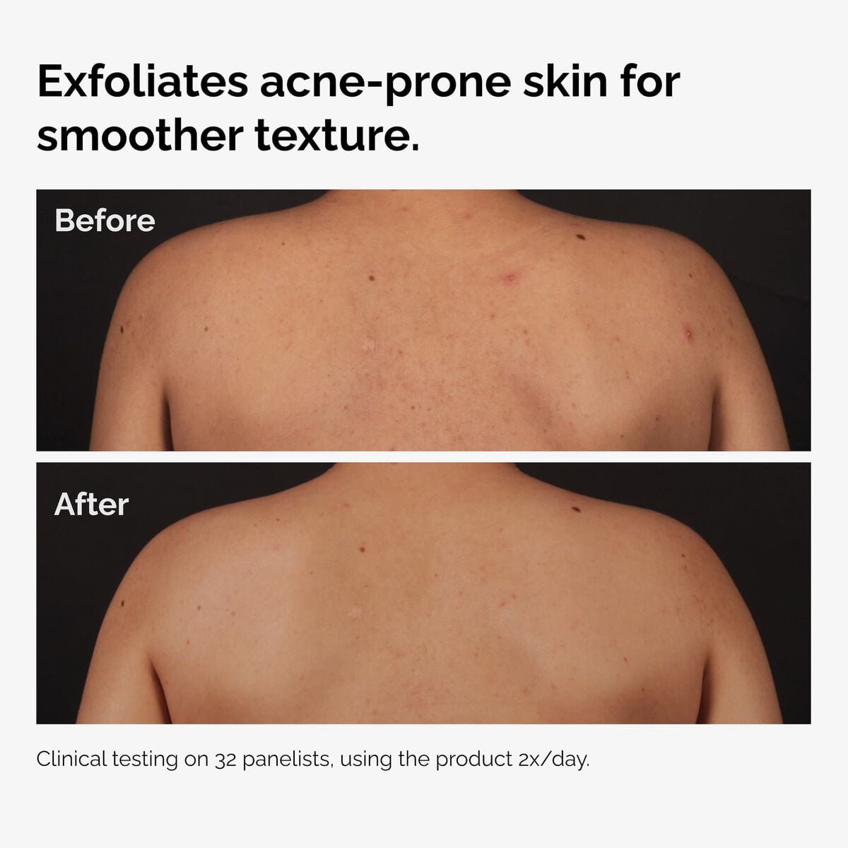 salicylic-acid-0-5-body-serum-l4 ord-salicylic-acid-body-serum-before-after-graphic-NA.jpg